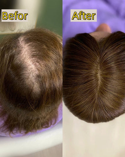Straight Hair Topper for Crown Thinning – Natural Coverage at the Crown